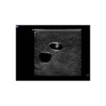 IJ_central_venous_access_ultrasound