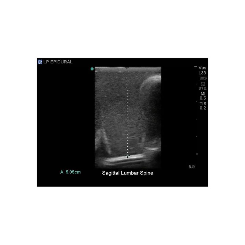 lumbar_puncture_ultrasound_sg