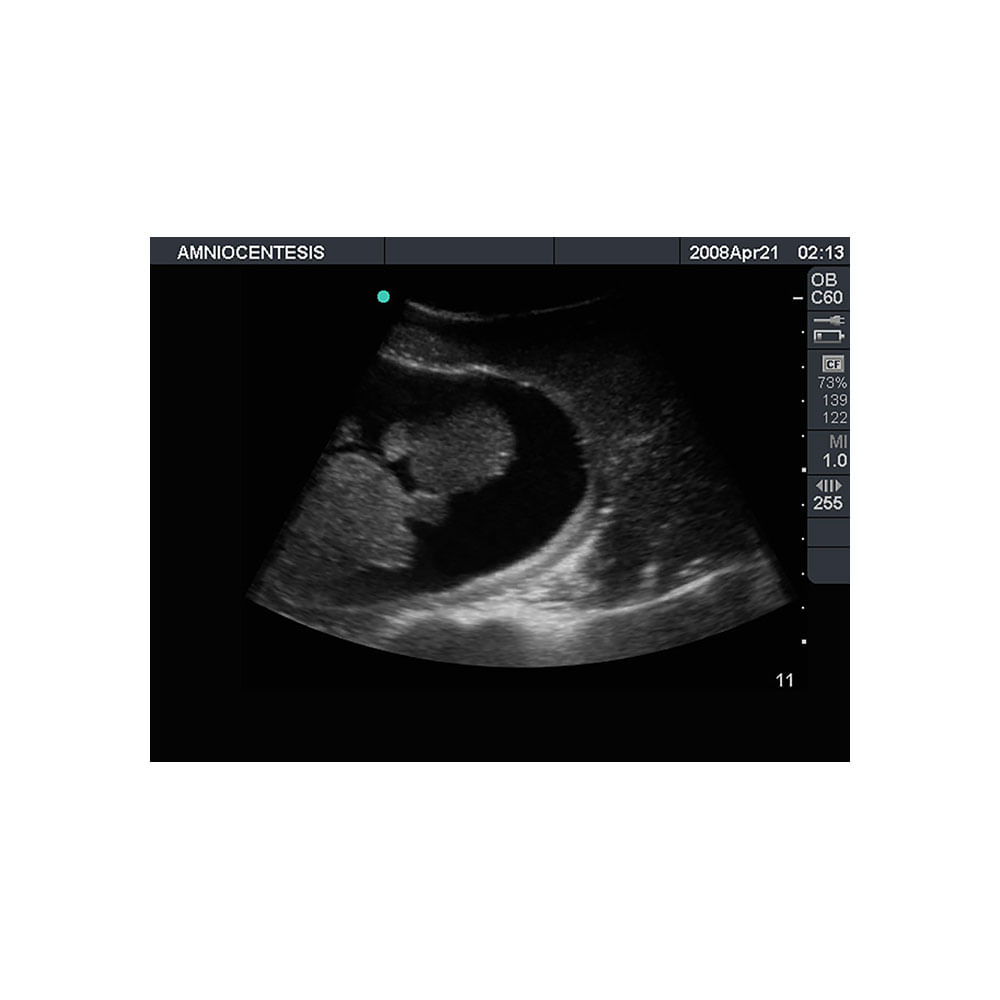 amniocentesis ultrasound