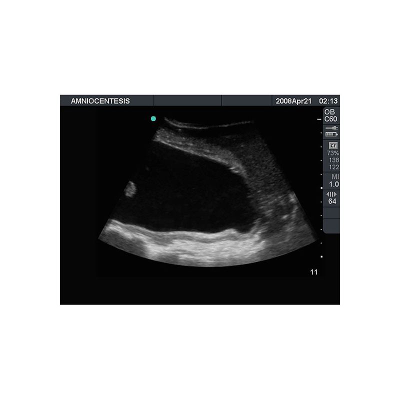 ultrasound_amniocentesis_cervix_needle