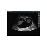 amniocentesis_ultrasound_training_model