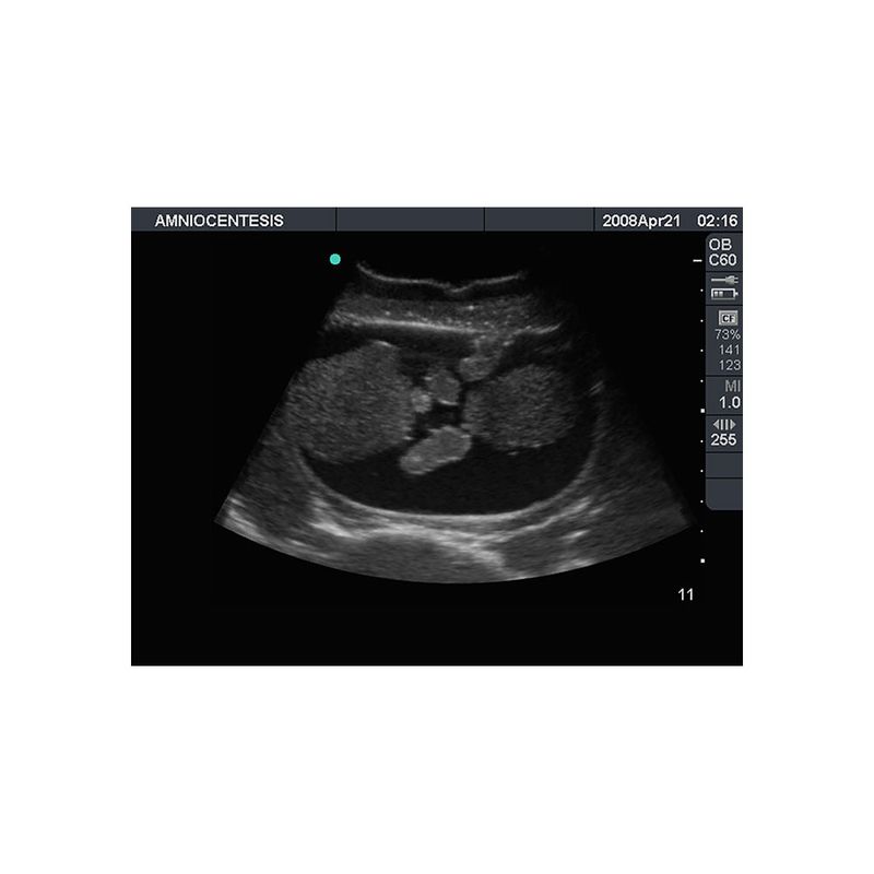 ultrasound_guided_amniocentesis_umbilical_cord