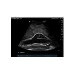 sagittal_aaa_ultrasound_medical_training_model
