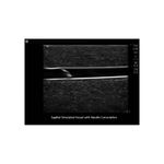 venous_access_ultrasound_2_vessel_sagittal_needle