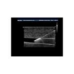 needle_pediatric_ultrasound_vascular_access_training