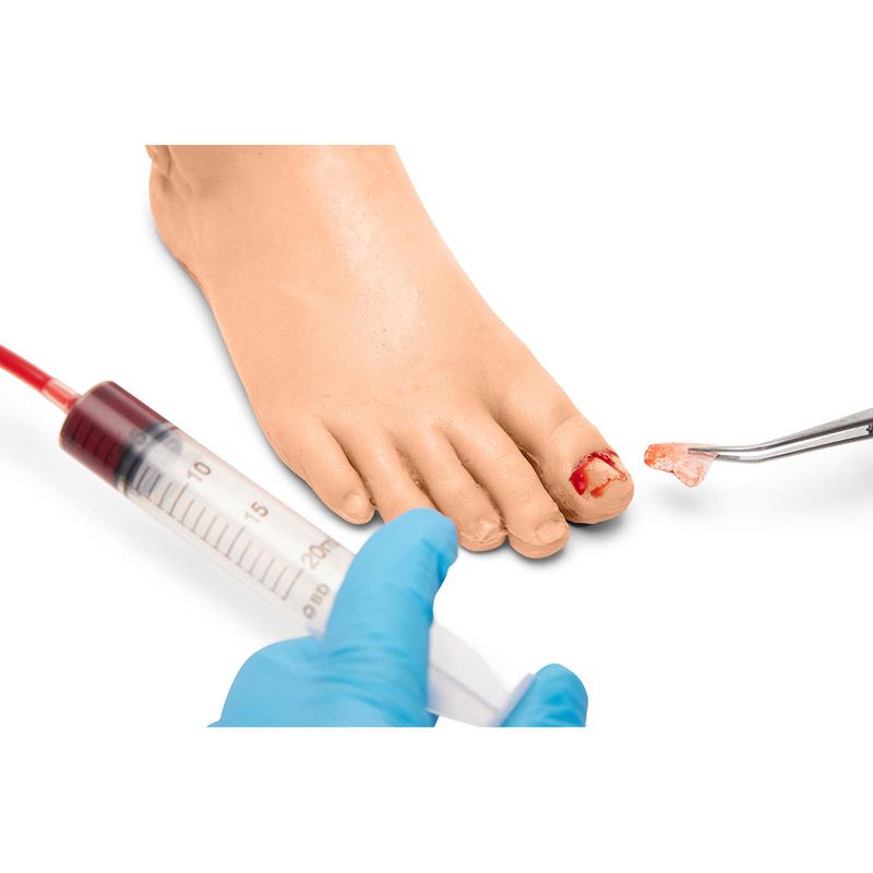 Toenail Removal