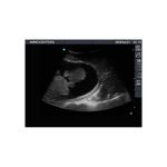 amniotic_fluid_aspiration_ultrasound_phantom_mannequin