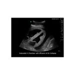 ultrasound_pericardial_effusion_pericardiocentesis