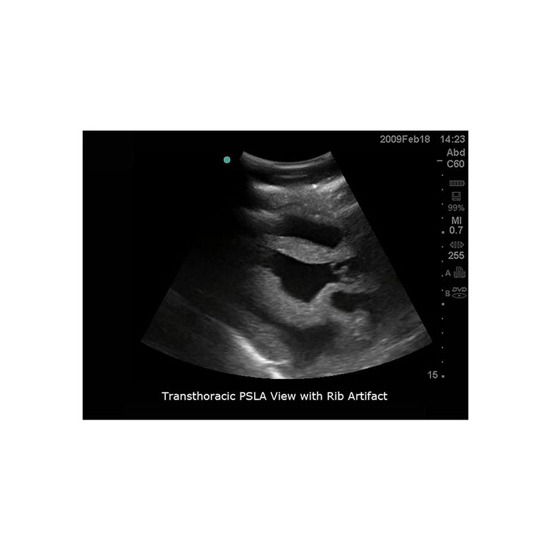 cardiac_ultrasound_training_pericardiocentesis