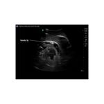 ultrasound_pericardiocentesis_mannequin_needle