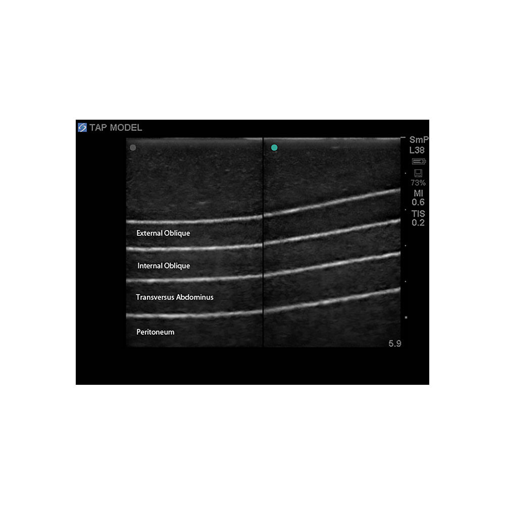 tap-nerve-block-ultrasound-training-model