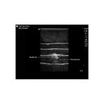 ultrasound_guided_tap_block_injection_sagittal