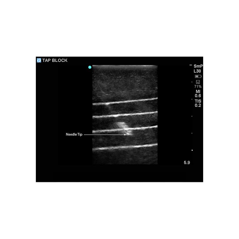 ultrasound_guided_tap_block_needle_sagittal
