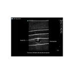 ultrasound_guided_tap_block_injection_transverse