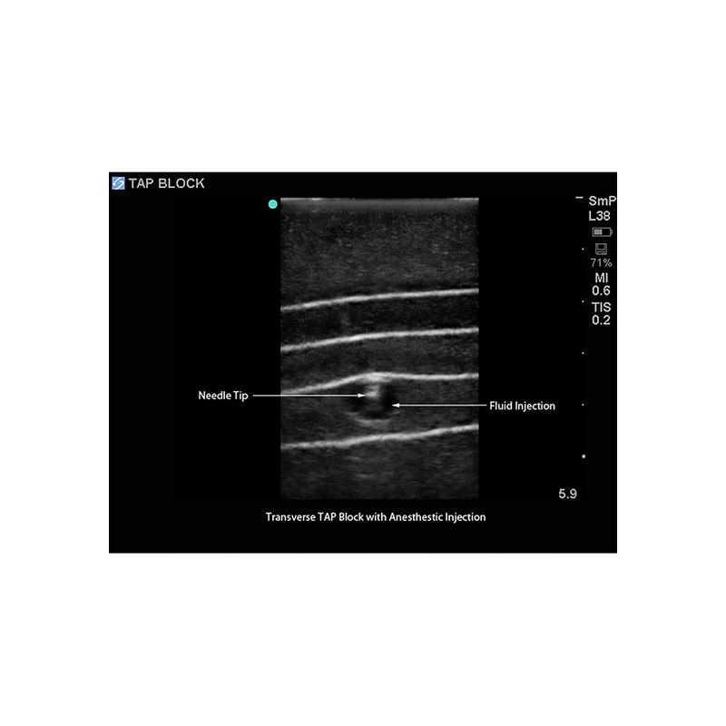 ultrasound_guided_tap_block_injection_transverse