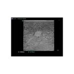 echogenic_elastography_ultrasound
