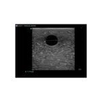 hypoechoic_elastography_ultrasound