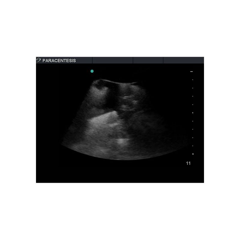 paracentesis_ultrasound_training_model_peritoneal_fluid