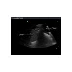 peritoneal_fluid_paracentesis_ultrasound_training_model