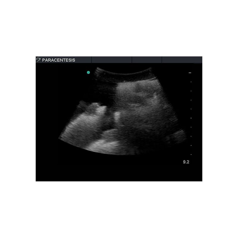 paracentesis_ultrasound_training_phantom_peritoneal_fluid