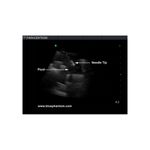peritoneal_fluid_paracentesis_ultrasound_training_phantom
