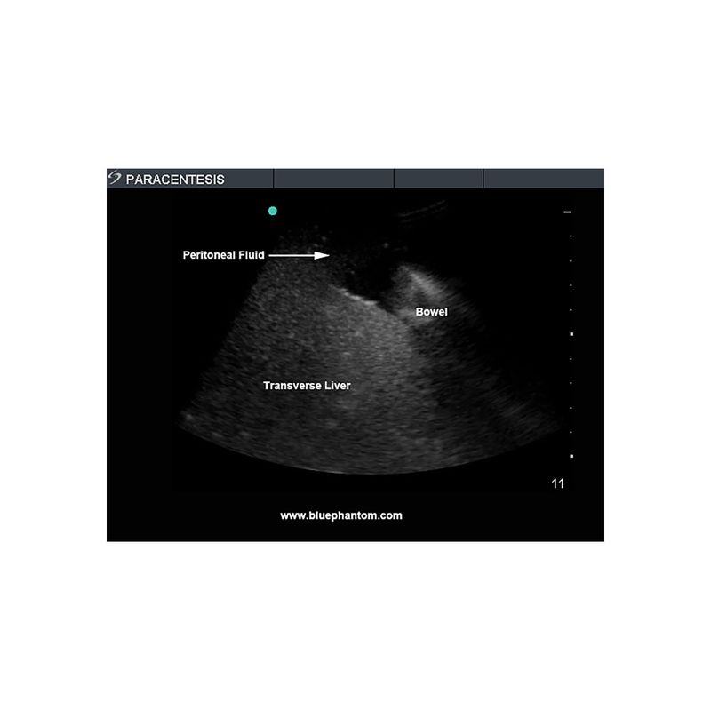 paracentesis_ultrasound_training_mannequin_peritoneal_fluid