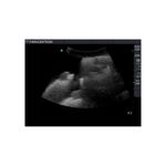 paracentesis_ultrasound_peritoneal_fluid