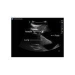 pleural_effusion_thoracentesis_ultrasound_training_model