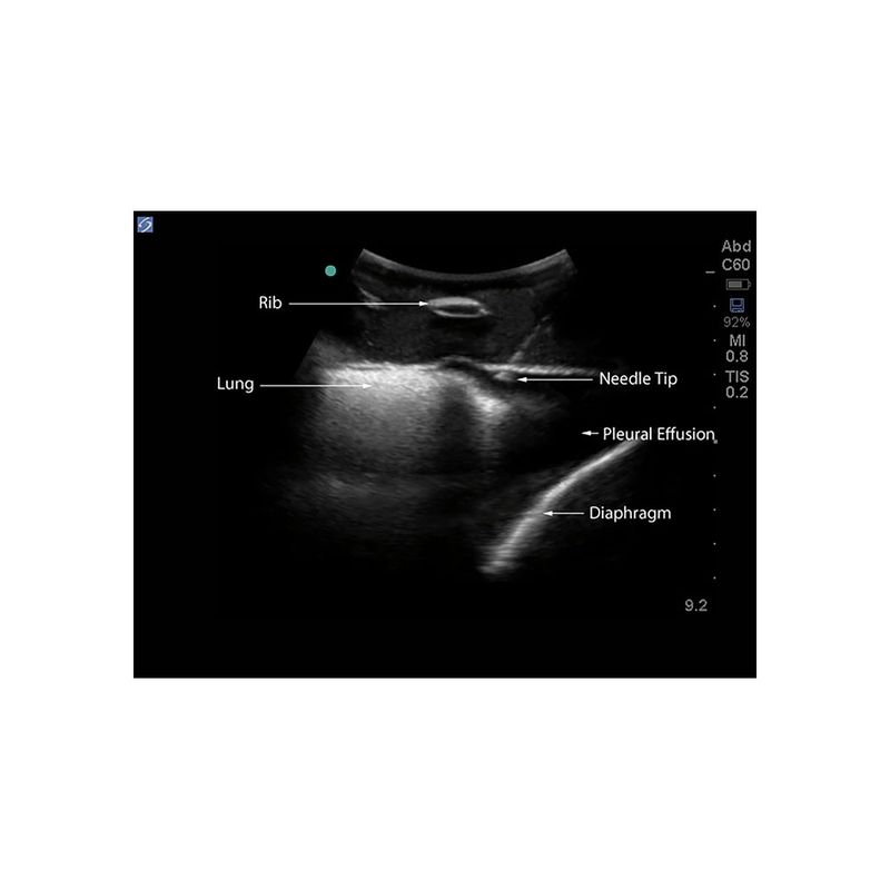 thoracentesis_ultrasound_image