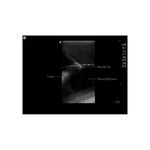 Ultrasound_image_thoracentesis