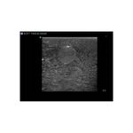 echogenic_soft_tissue_biopsy_ultrasound