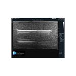 needle_foreign_body_ultrasound