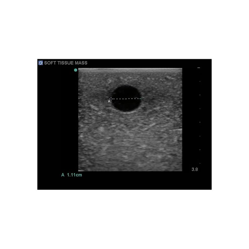 hypoechoic_soft_tissue_biopsy_ultrasound