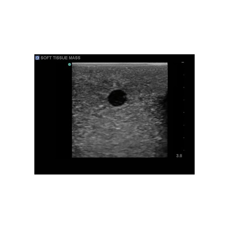 small_soft_tissue_mass_biopsy_ultrasound
