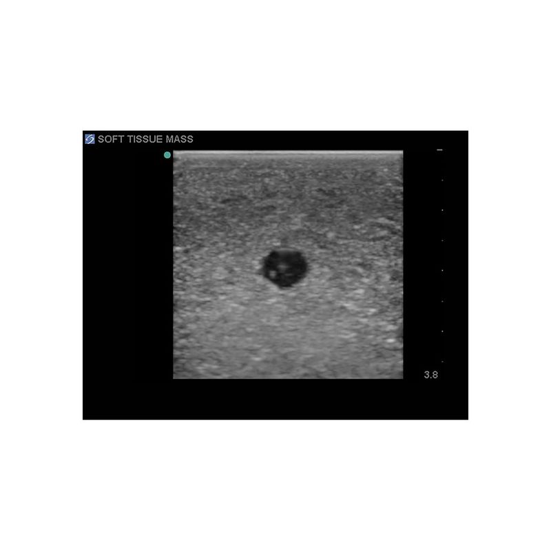 hypoechoic_needle_biopsy_tissue_ultrasound