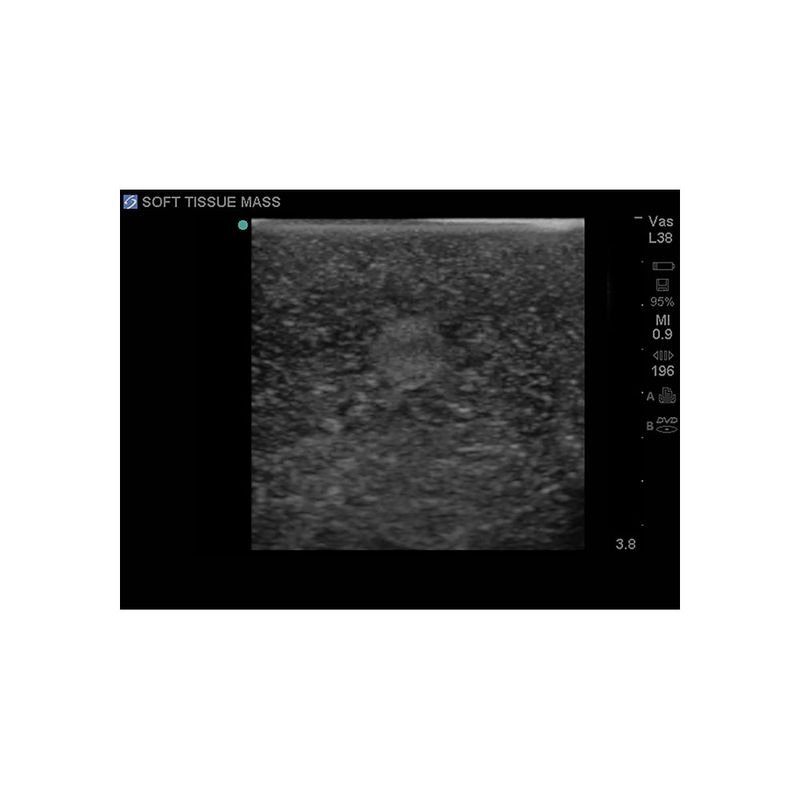 soft_tissue_biopsy_ultrasound_image