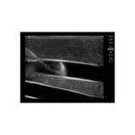 central_line_guidewire_ultrasound_image