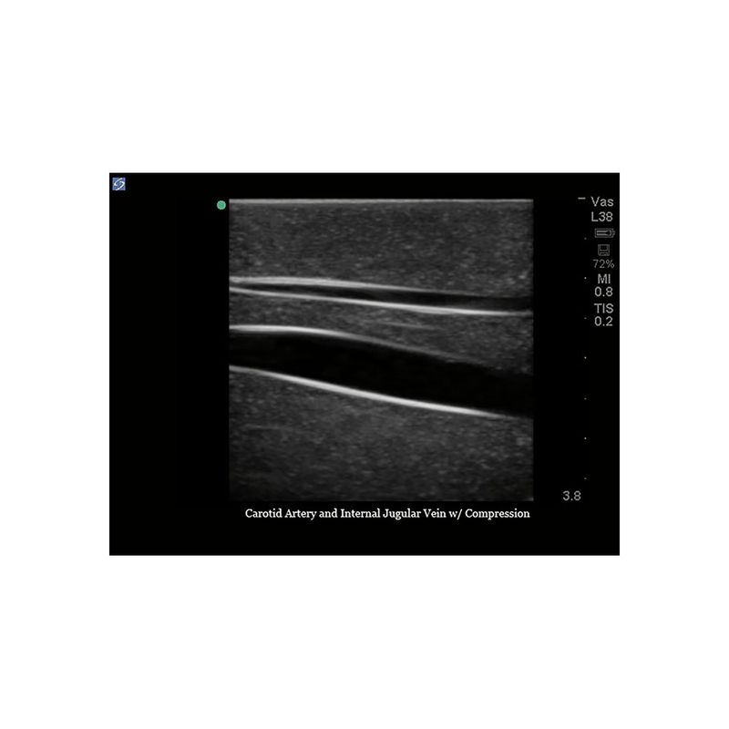 central_venous_lines_ultrasound