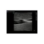 ultrasound_catheter_IJ_central_venous_access_training