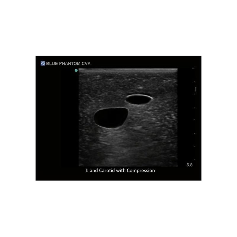 jugular_central_venous_access_regional_anesthesia_imaging