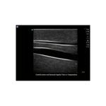 central_venous_lines_ultrasound