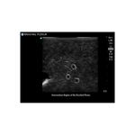 supraclavicular_nerves_ultrasound