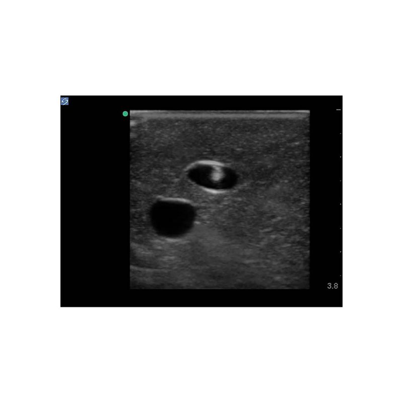 supraclavicular_plexus_block_ultrasound