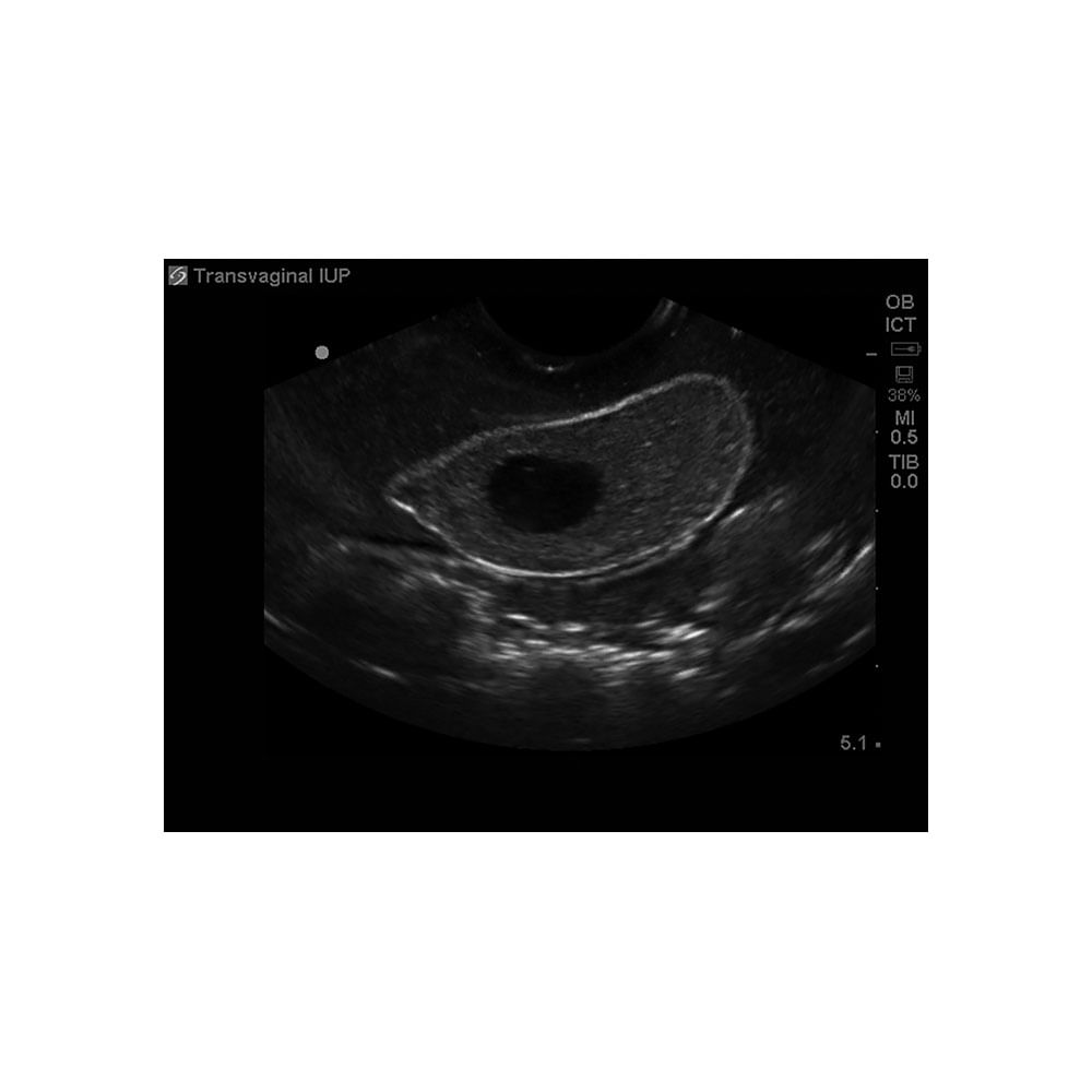 7 week transvaginal ultrasound