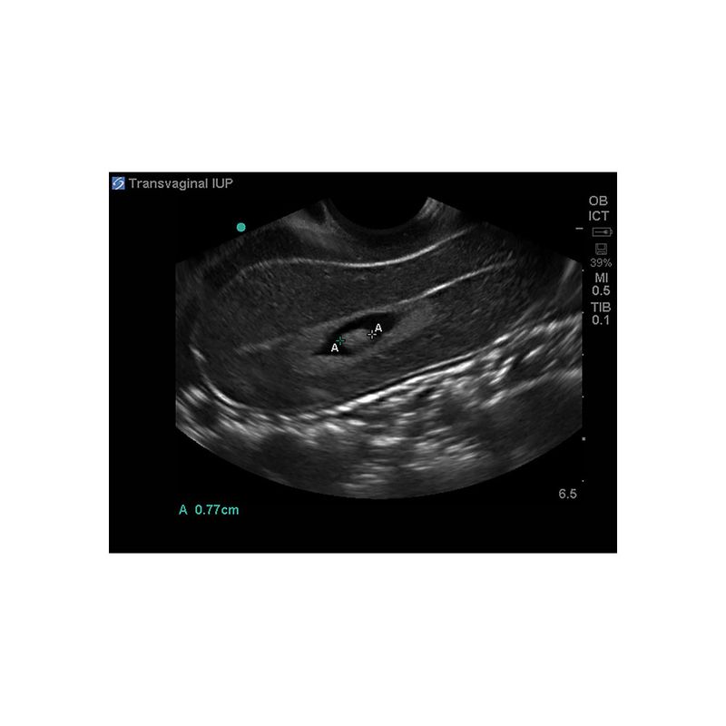 sagittal_uterus_intrauterine_pregnancy_transvaginal_ultrasound