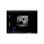 sagittal_ovarian_cyst_endovaginal_ultrasound_phantom