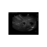 transvaginal_ectopic_pregnancy_ultrasound_training_mannequin