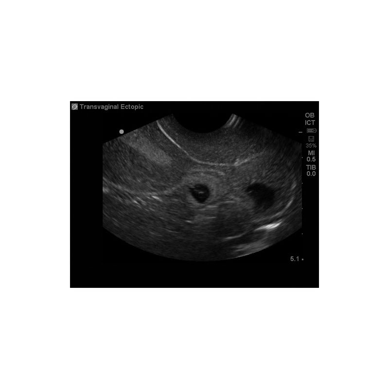 transvaginal_ectopic_pregnancy_ultrasound_training_mannequin