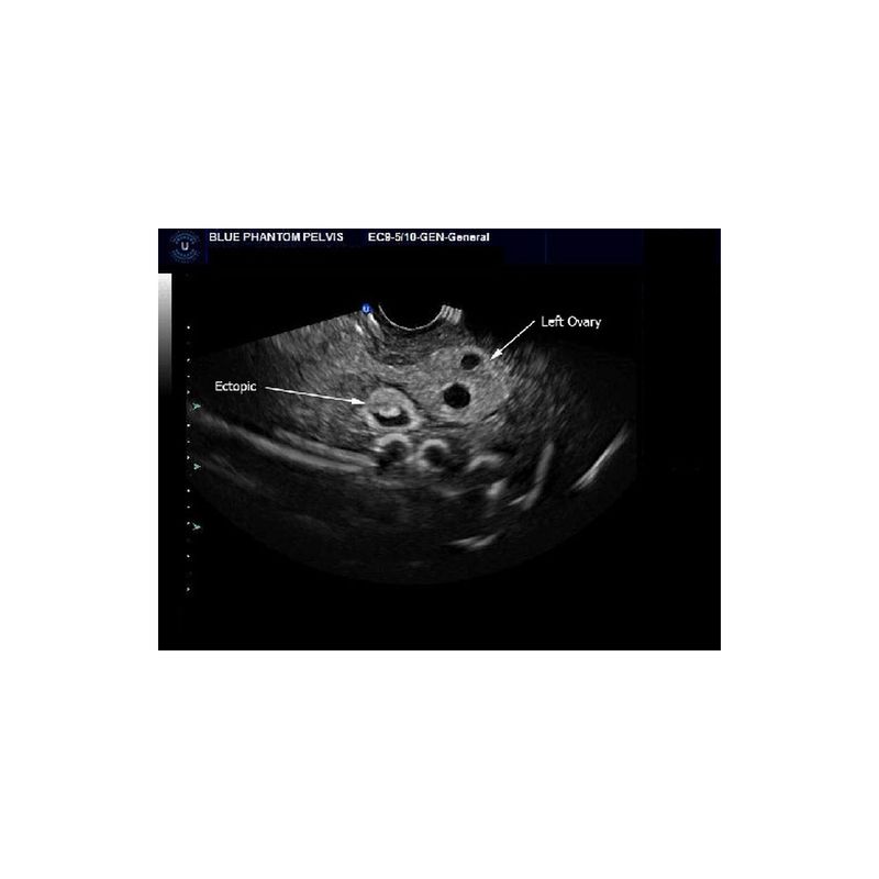 Ectopic_pregnancy_endovaginal_ultrasound_training_phantom